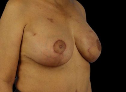 DIEP Flap Before & After Patient #3030