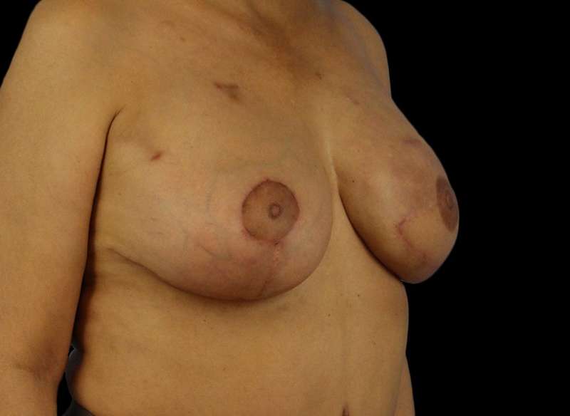 DIEP Flap Before & After Patient #3030