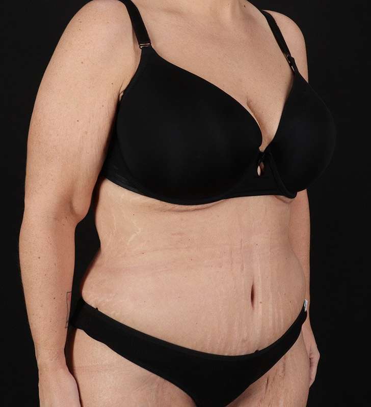 Abdominoplasty (Tummy Tuck) Before & After Patient #817