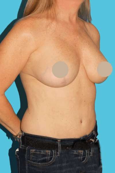 DIEP Flap Before & After Patient #3096