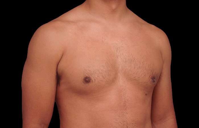 Gynecomastia Before & After Patient #3130