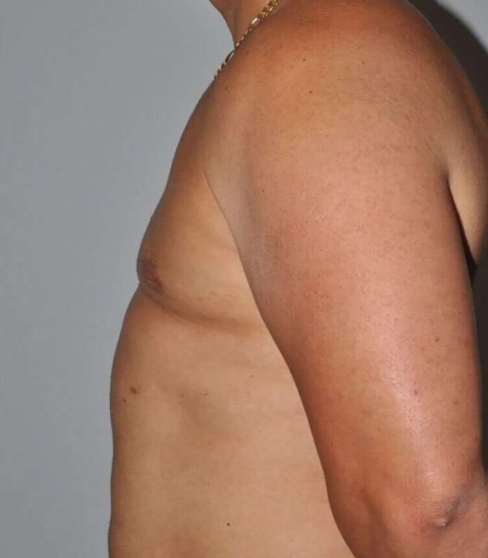 Gynecomastia Before & After Patient #3135