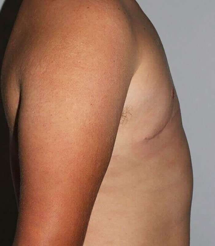 Gynecomastia Before & After Patient #3140