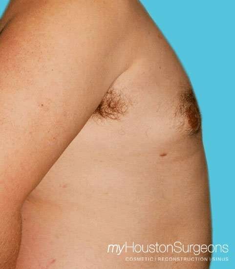 Gynecomastia Before & After Patient #3145