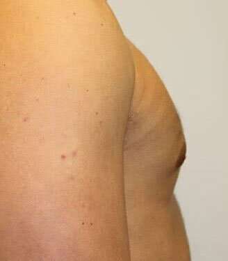 Gynecomastia Before & After Patient #3151