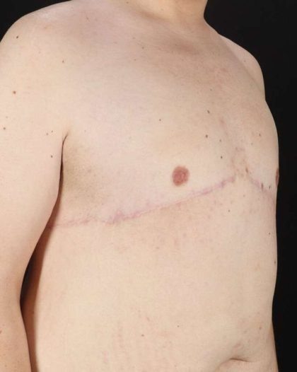 Gynecomastia Before & After Patient #3162