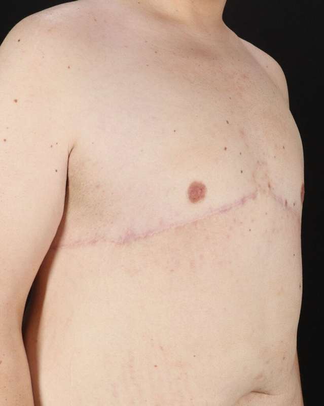 Gynecomastia Before & After Patient #3162