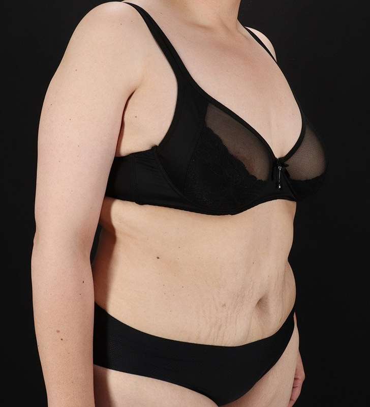 Abdominoplasty (Tummy Tuck) Before & After Patient #830