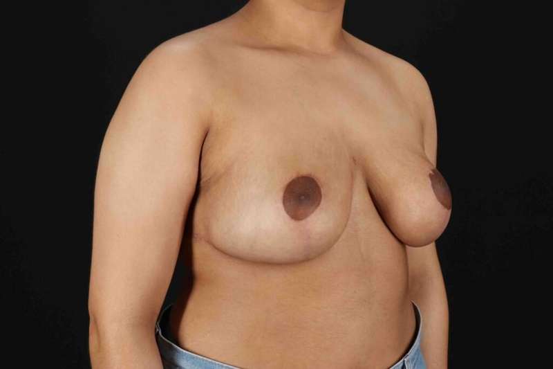 Breast Reduction With Lift Before & After Patient #3301