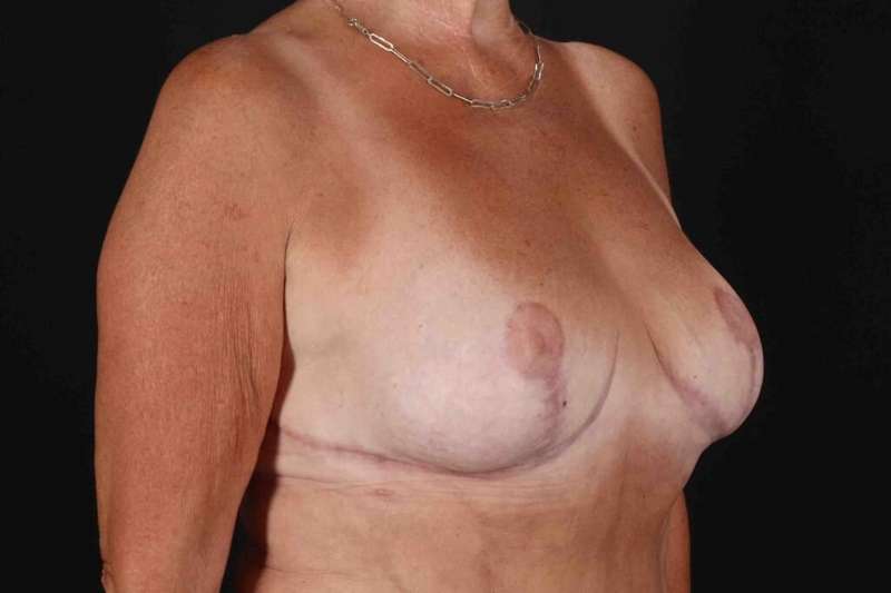 Breast Reduction With Lift Before & After Patient #3312