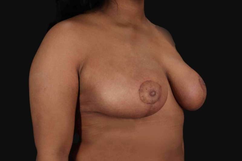 Breast Reduction With Lift Before & After Patient #3422