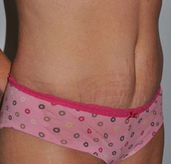Abdominoplasty (Tummy Tuck) Before & After Patient #855