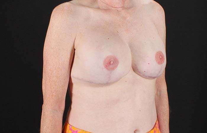 Implant Based Reconstruction Before & After Patient #3527