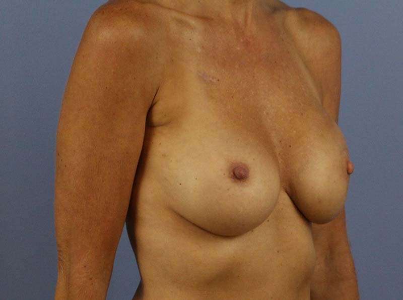 Implant Based Reconstruction Before & After Patient #3538