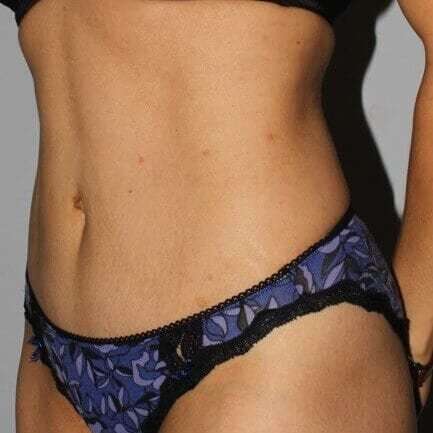 Abdominoplasty (Tummy Tuck) Before & After Patient #862