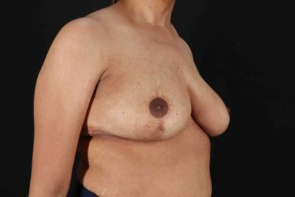 Breast Lift Before & After Patient #3626