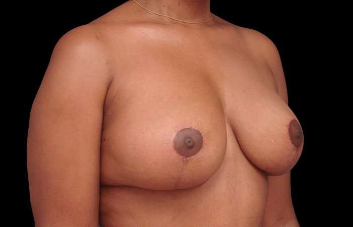 Breast Lift Before & After Patient #3640