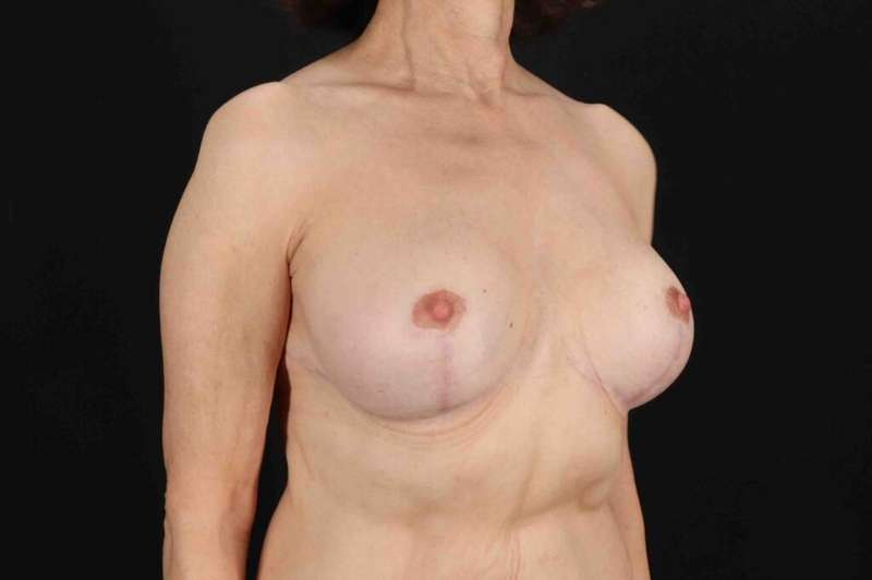 Breast Lift Before & After Patient #3662