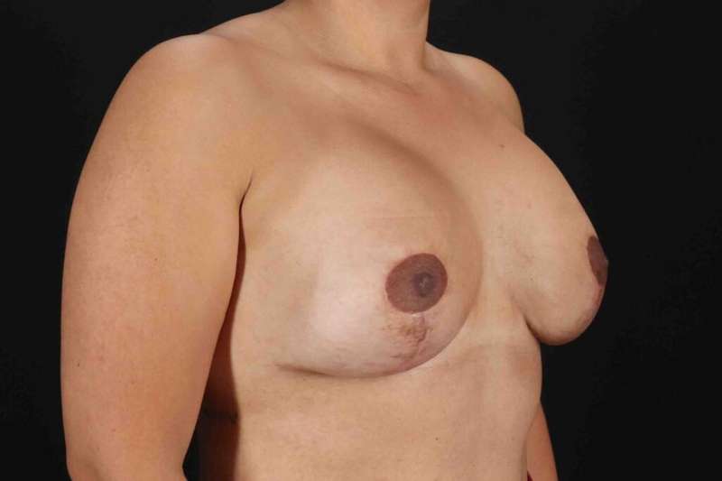 Breast Lift Before & After Patient #3717