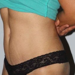 Abdominoplasty (Tummy Tuck) Before & After Patient #867