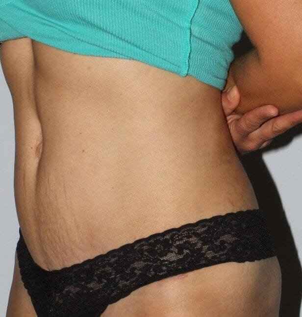 Abdominoplasty (Tummy Tuck) Before & After Patient #867