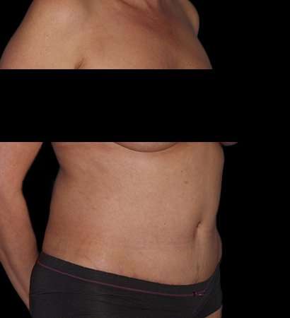 Abdominoplasty (Tummy Tuck) Before & After Patient #590