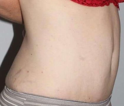 Abdominoplasty (Tummy Tuck) Before & After Patient #874