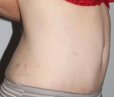 Abdominoplasty (Tummy Tuck) Before & After Patient #874