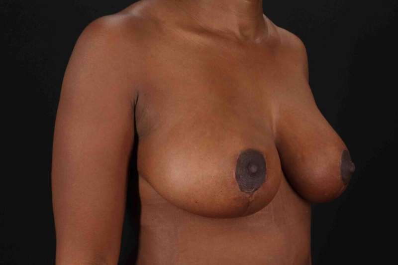 Breast Lift Before & After Patient #3875
