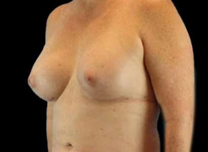 Male To Female Breast Before & After Patient #3893