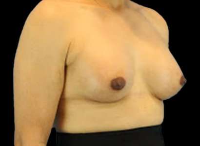 Male To Female Breast Before & After Patient #3900