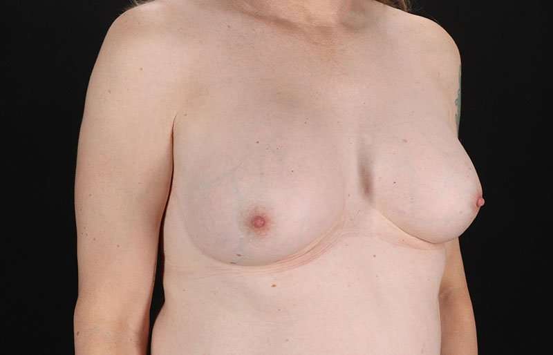 Male To Female Breast Before & After Patient #3922