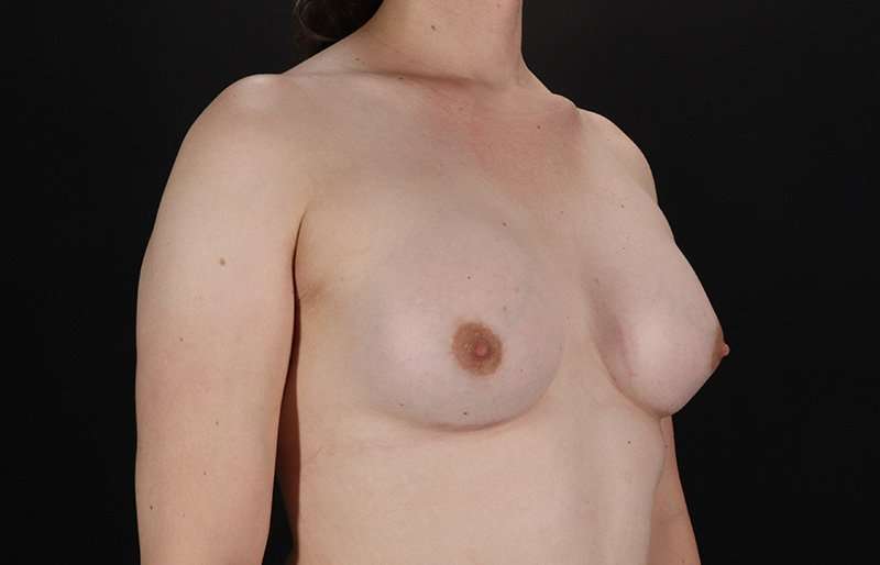 Male To Female Breast Before & After Patient #3933