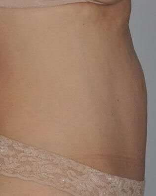 Abdominoplasty (Tummy Tuck) Before & After Patient #881