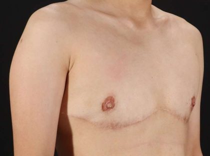 Female To Male Breast Before & After Patient #3944