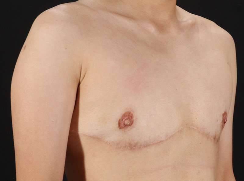 Female To Male Breast Before & After Patient #3944