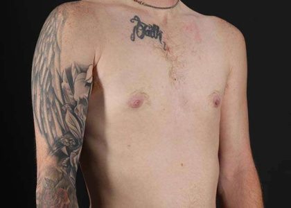 Female To Male Breast Before & After Patient #3955