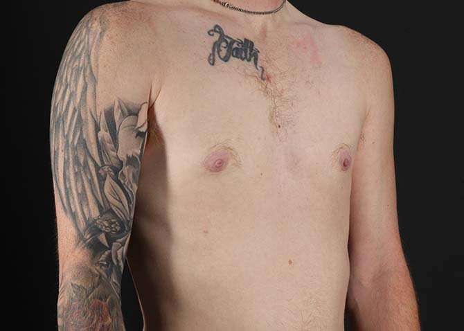 Female To Male Breast Before & After Patient #3955