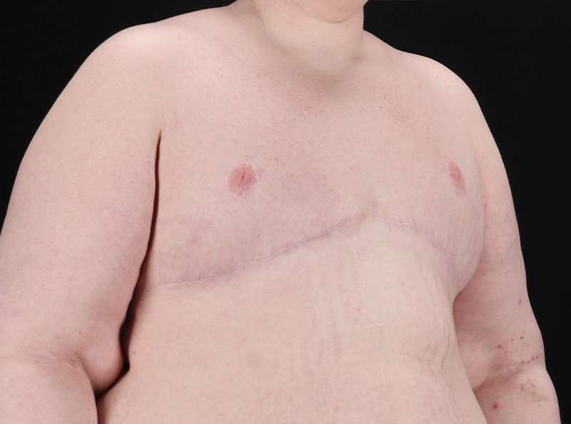Female To Male Breast Before & After Patient #3966