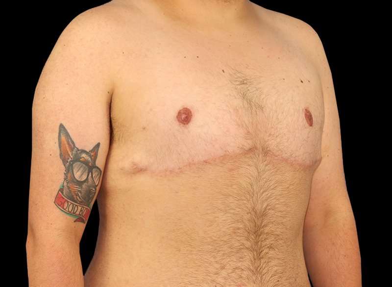 Female To Male Breast Before & After Patient #3977