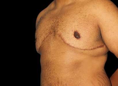 Female To Male Breast Before & After Patient #3984