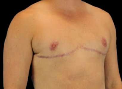 Female To Male Breast Before & After Patient #3991