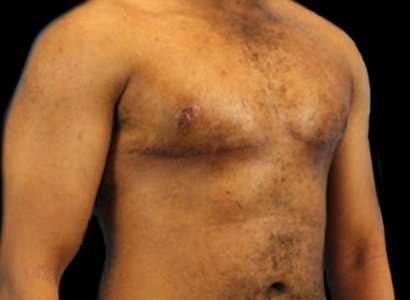 Female To Male Breast Before & After Patient #3998