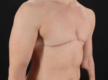Female To Male Breast Before & After Patient #4009