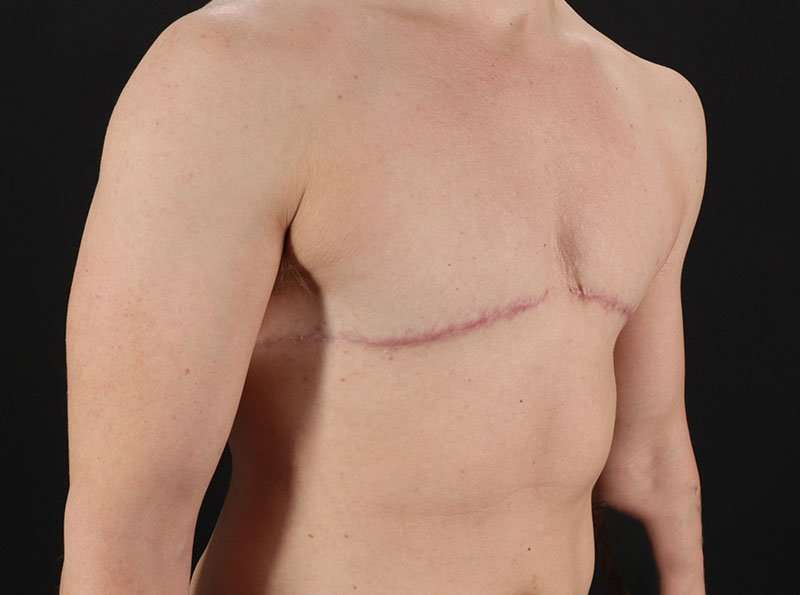 Female To Male Breast Before & After Patient #4009