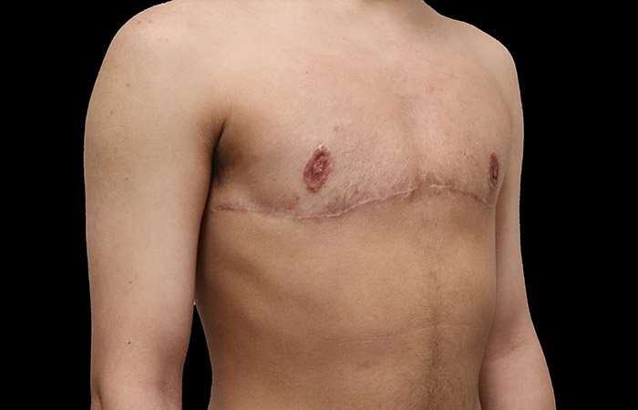 Female To Male Breast Before & After Patient #4020