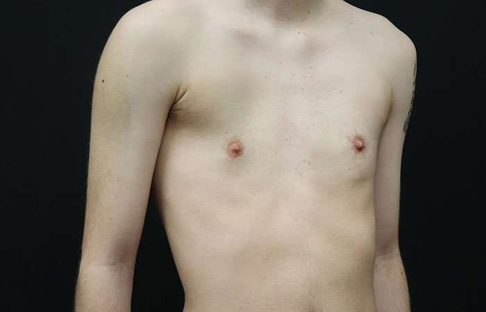 Female To Male Breast Before & After Patient #4031