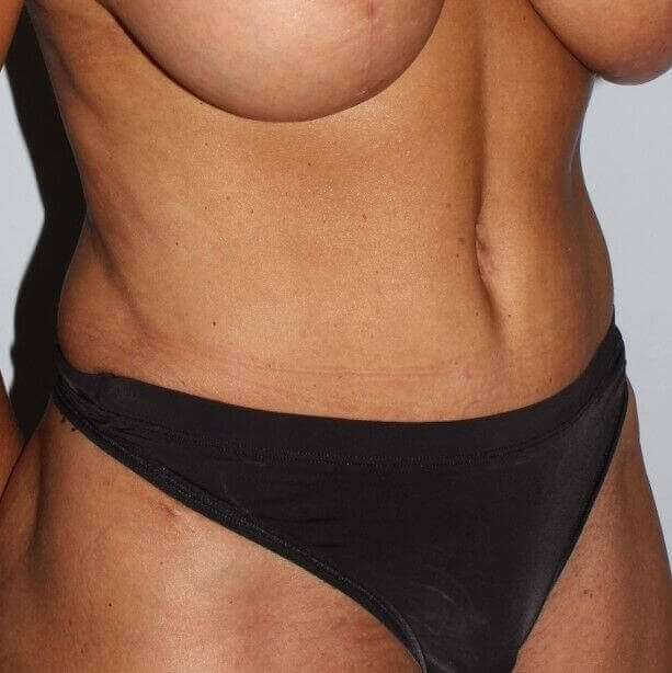 Abdominoplasty (Tummy Tuck) Before & After Patient #889