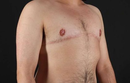 Female To Male Breast Before & After Patient #4042