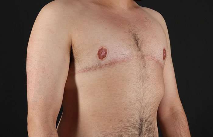 Female To Male Breast Before & After Patient #4042